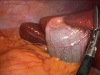 laparoscopic-picture-of-gallbladder-and-liver