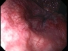 colonoscopy-of-internal-hemorrhoids